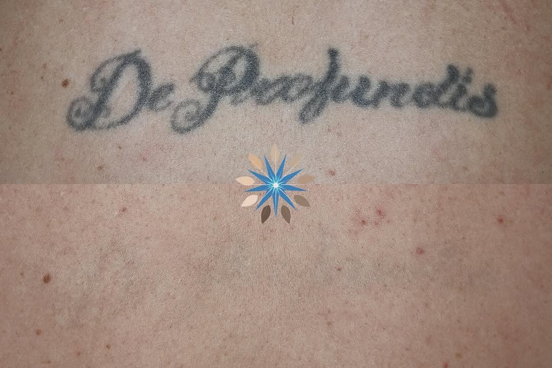 Instagram post by Dr. Thomas Adrian: De Produndis - ‘out if the depths’. We lifted this ink out of the depths during 6 painless treatment sessions over a 9 month period using th…