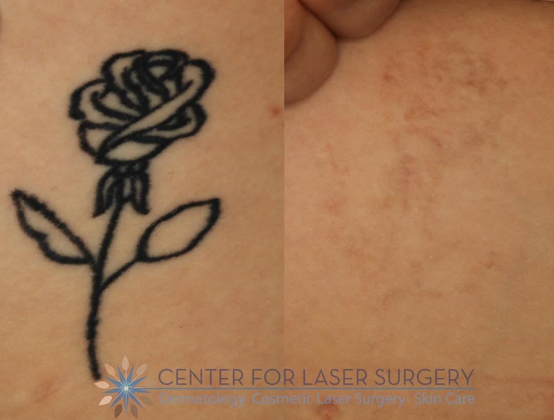Instagram post by Dr. Thomas Adrian: Tattoo Tuesday featuring some awesome before and afters! ————————— BOOK WITH US ➾ 202 966-8814 ➾ lasersurgery.com ➾ Info@lasersurgery #board…