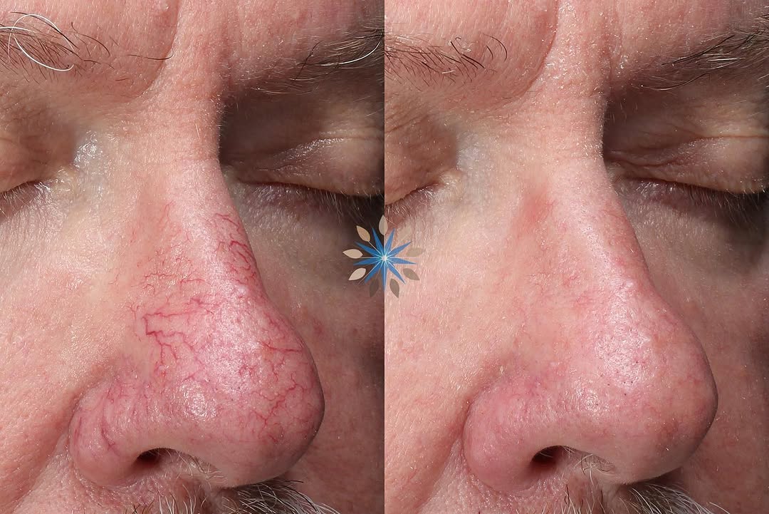 Instagram post by Dr. Thomas Adrian: Referred to by many names (broken capillaries, telangiectasia) but universally disliked, facial blood vessels are due to a combination of ge…