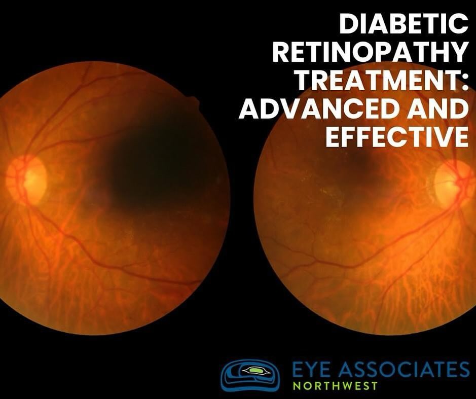 Instagram post by Dr. Thomas Copperman: Early detection and prompt treatment are pivotal in managing diabetic retinopathy. At Eye Associates Northwest, we stay at the forefront of …