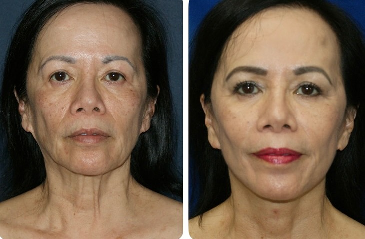 Instagram post by Dr. Thomas D Toohey: Dr. Toohey performed a facelift on this lovely 70 years young patient. Very natural and beautiful results. Call today to book your complimen…