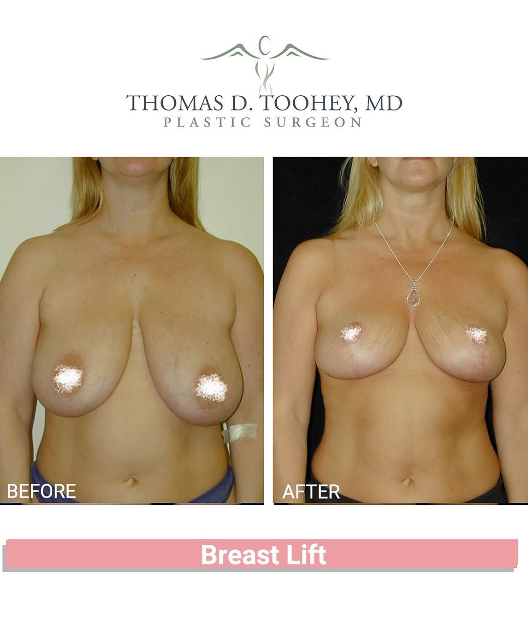 Instagram post by Dr. Thomas D Toohey: Breast lift by Dr. Toohey 😍 Call today to book your complimentary consultation with Dr. Toohey @949-759-8700
