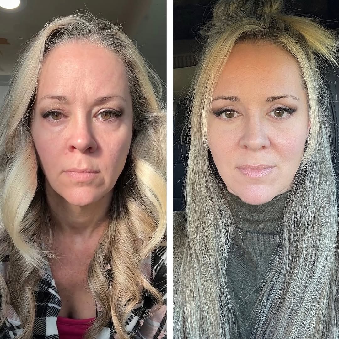 Instagram post by Dr. Thomas D Toohey: Dr. Toohey gives such natural and beautiful results. This patient had upper and lower eyes done. She looks great😍 Call today to book your c…