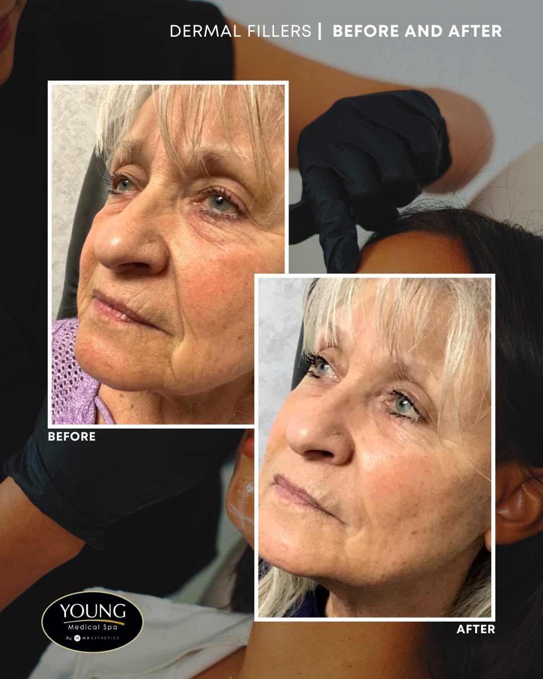 Instagram post by Dr. Thomas E. Young: Subtle refinement, customized to the patient.⁠ ⁠ Dermal filler treatments at Young Medical Spa are designed to help restore lost volume, sof…