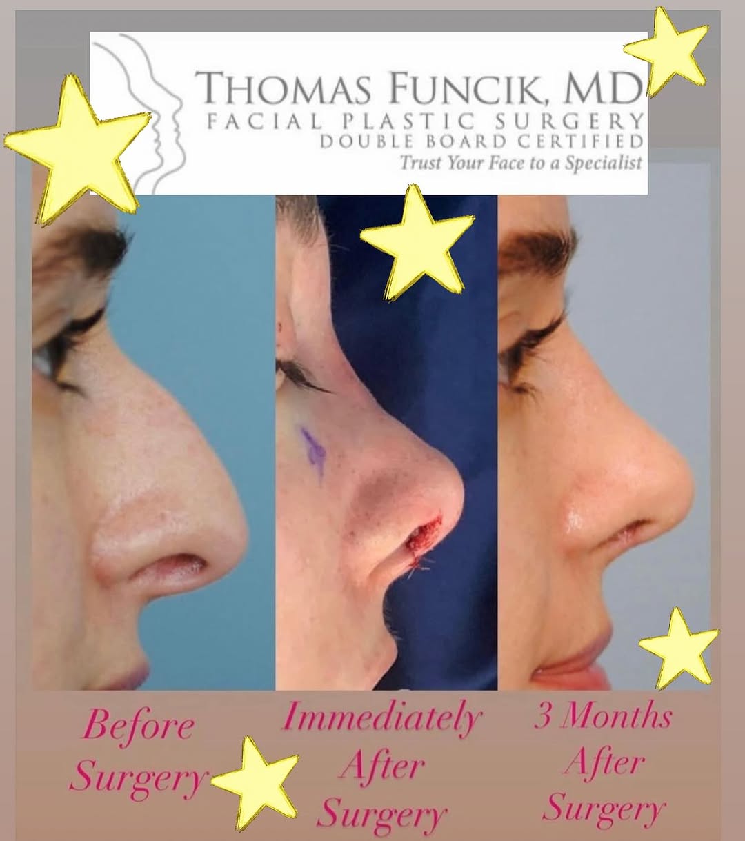 Instagram post by Dr. Thomas Funcik: Rhinoplasty is one of our most popular procedures! Dr Funcik is double board certified in facial plastic surgery AND ENT. He produces beauti…