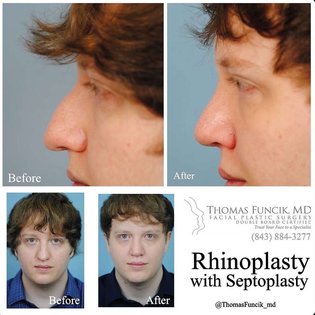 Instagram post by Dr. Thomas Funcik: Rhinoplasty is one of the most popular procedures we do here @thomasfuncik_md. Dr. Funcik is double board certified in facial plastics AND E…