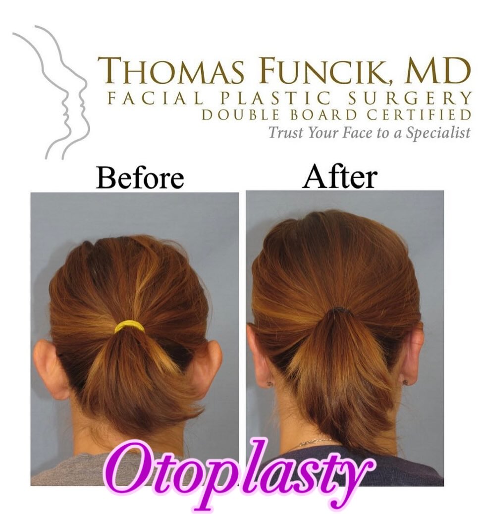Instagram post by Dr. Thomas Funcik: Ears that naturally protrude out from the head, are misshapen, or have been damaged due to an injury can be corrected or modified with a sim…