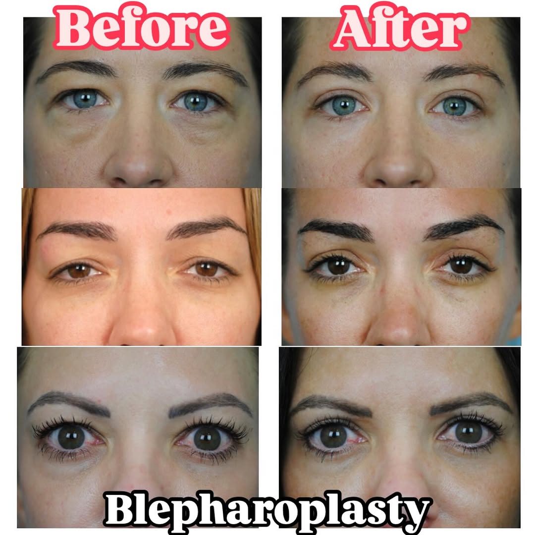 Instagram post by Dr. Thomas Funcik: Blepharoplasty, also known as eyelid surgery, is the most common procedure we do @thomasfuncik_md! But there is nothing routine about the wa…