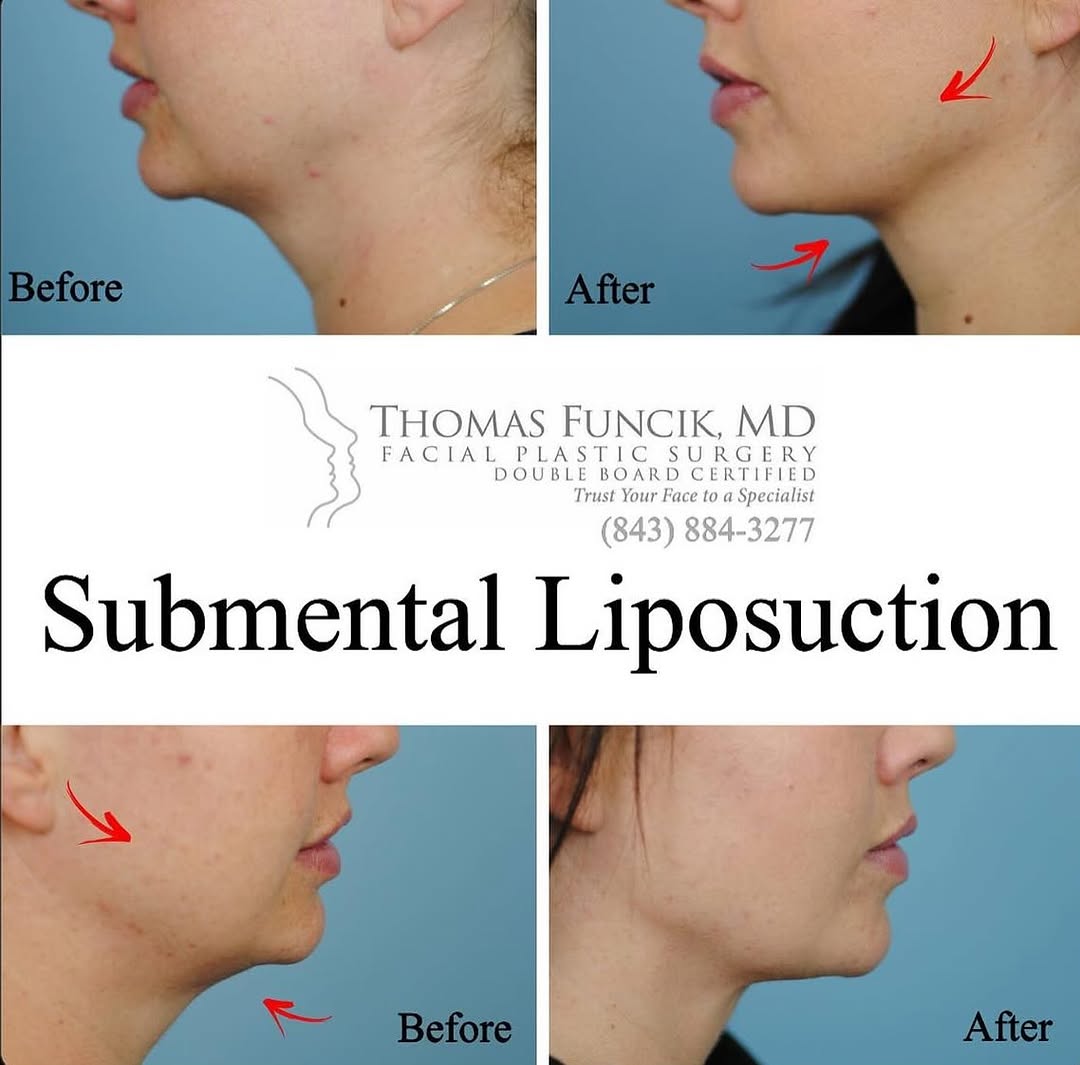 Instagram post by Dr. Thomas Funcik: Whether your double chin or the fullness below your jawline is a result of age, weight gain, or genetics, no one enjoys having it! Submental…
