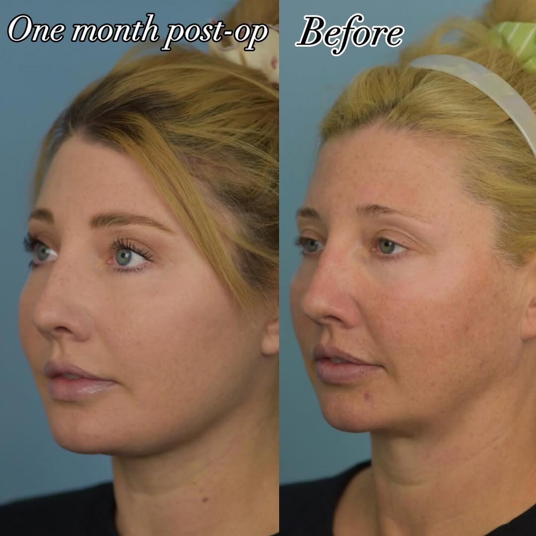 Instagram post by Dr. Thomas Funcik: Just ONE month after a facelift, fat grafting, and browlift, our nurse Lindsay couldn’t be happier with her beautiful results! It will conti…