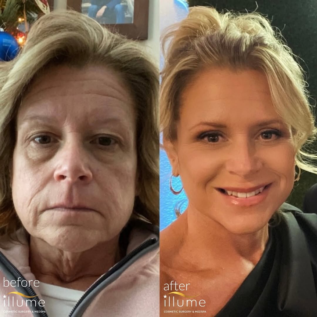 Instagram post by Dr. Thomas G. Korkos: Absolutely stunning Facelift result.✨ This beautiful patient shared her own updated before & after photos, 5.5 months post-op. (swipe to see…