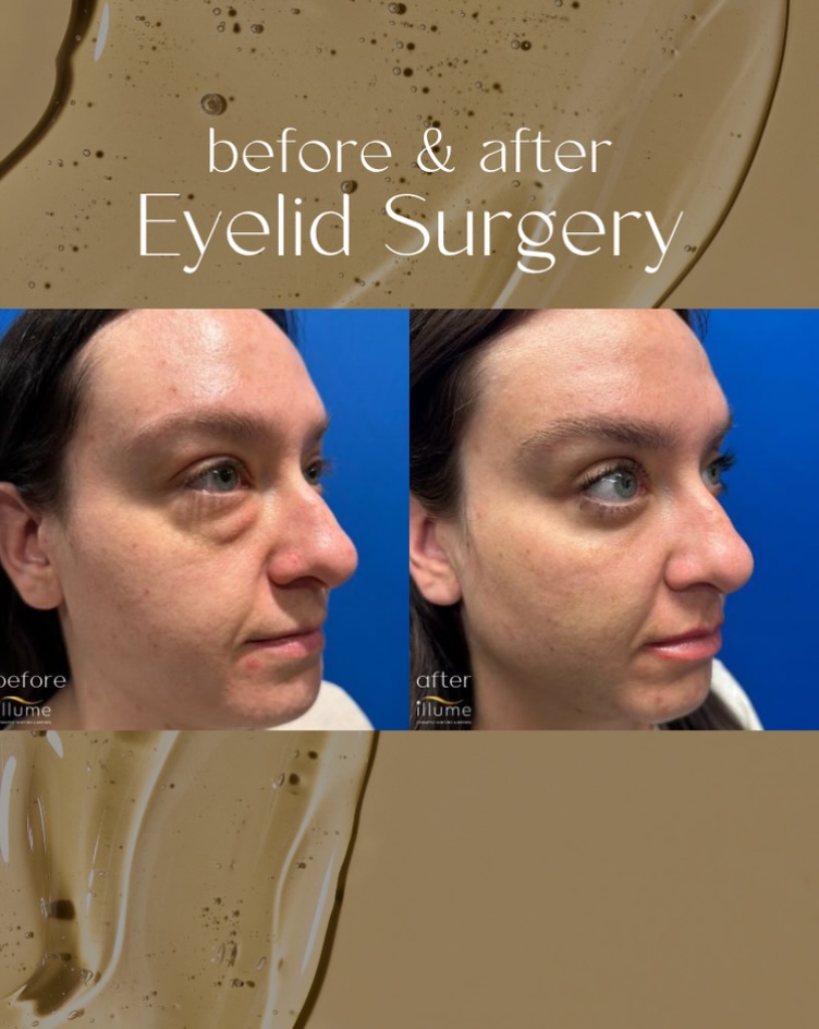 Instagram post by Dr. Thomas G. Korkos: Beautiful Eyelid Surgery result for this patient.🤍✨ Eyelid surgery, also known as Blepharoplasty, is a surgical procedure to improve the ap…