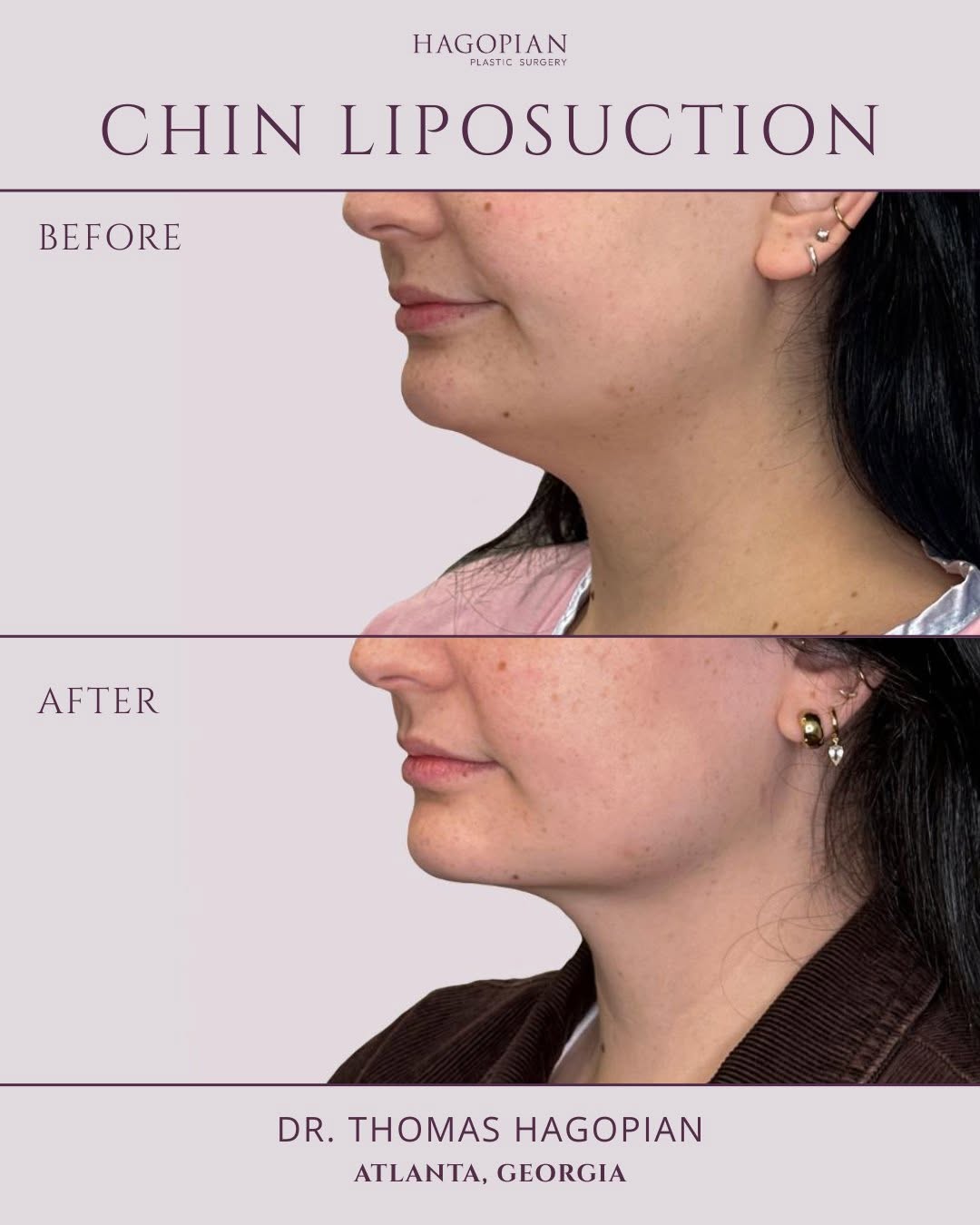 Instagram post by Dr. Thomas Hagopian: Proof that “subtle” and “significant” can exist in the same result. 👍 #DrHagopian #AtlantaPlasticSurgery #AtlantaPlasticSurgeon #ChinLiposu…