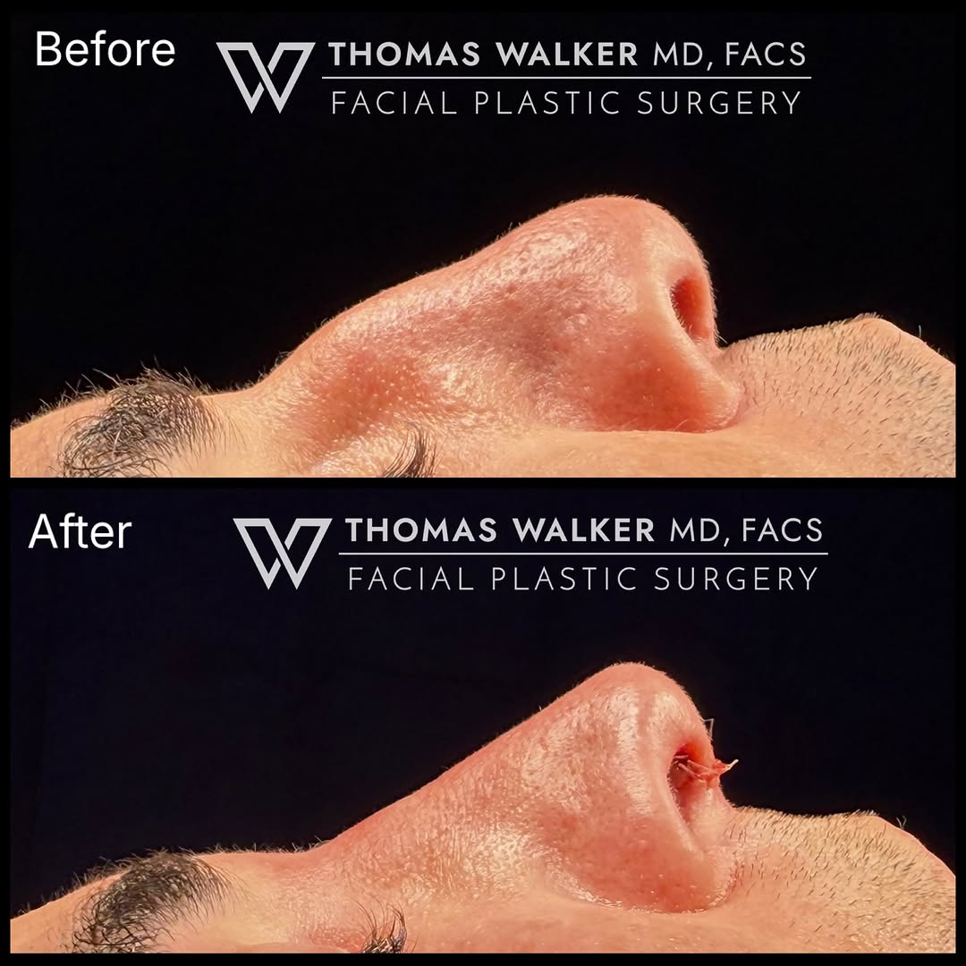 Instagram post by Dr. Thomas J. Walker: Just the tip of the iceberg. The nose was much worse than what the before picture suggests. On the inside, there was no septal cartilage lef…