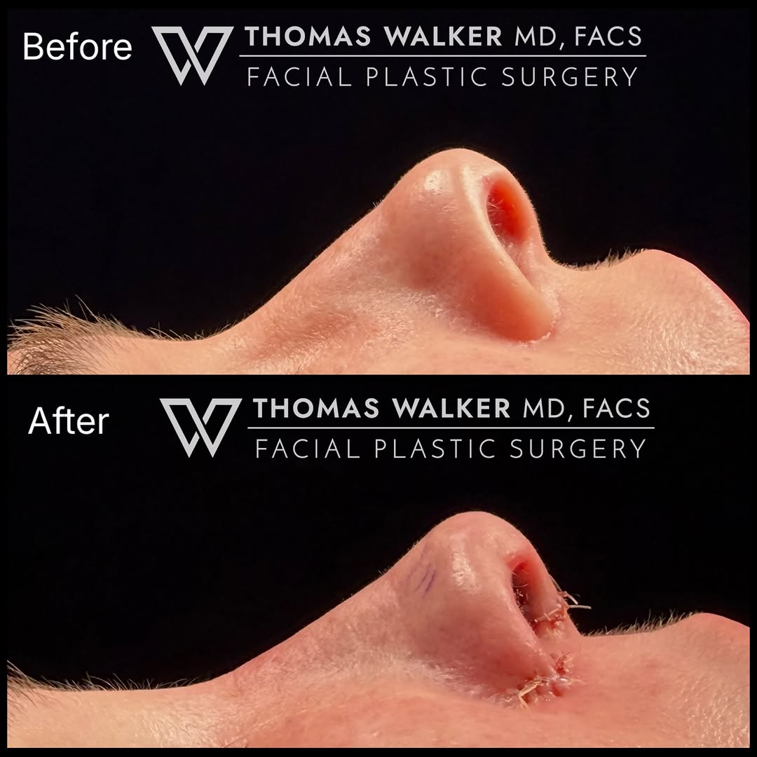 Instagram post by Dr. Thomas J. Walker: Sometimes less is more. Changes don’t have to be extreme to be meaningful. Details matter. Look at the nostrils and the alar-columellar rela…