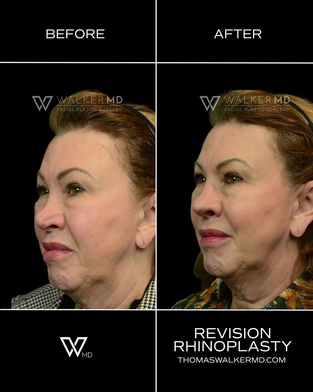 Instagram post by Dr. Thomas J. Walker: Following her reel, here is a look at two months after revision rhinoplasty with rib grafting for Elizabeth, who had undergone two previous …