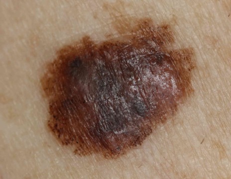 Instagram post by Dr. Thomas Munyon: Melanoma isn’t always obvious—but it can be life-threatening. From what we see on the surface to what’s happening under the microscope, earl…