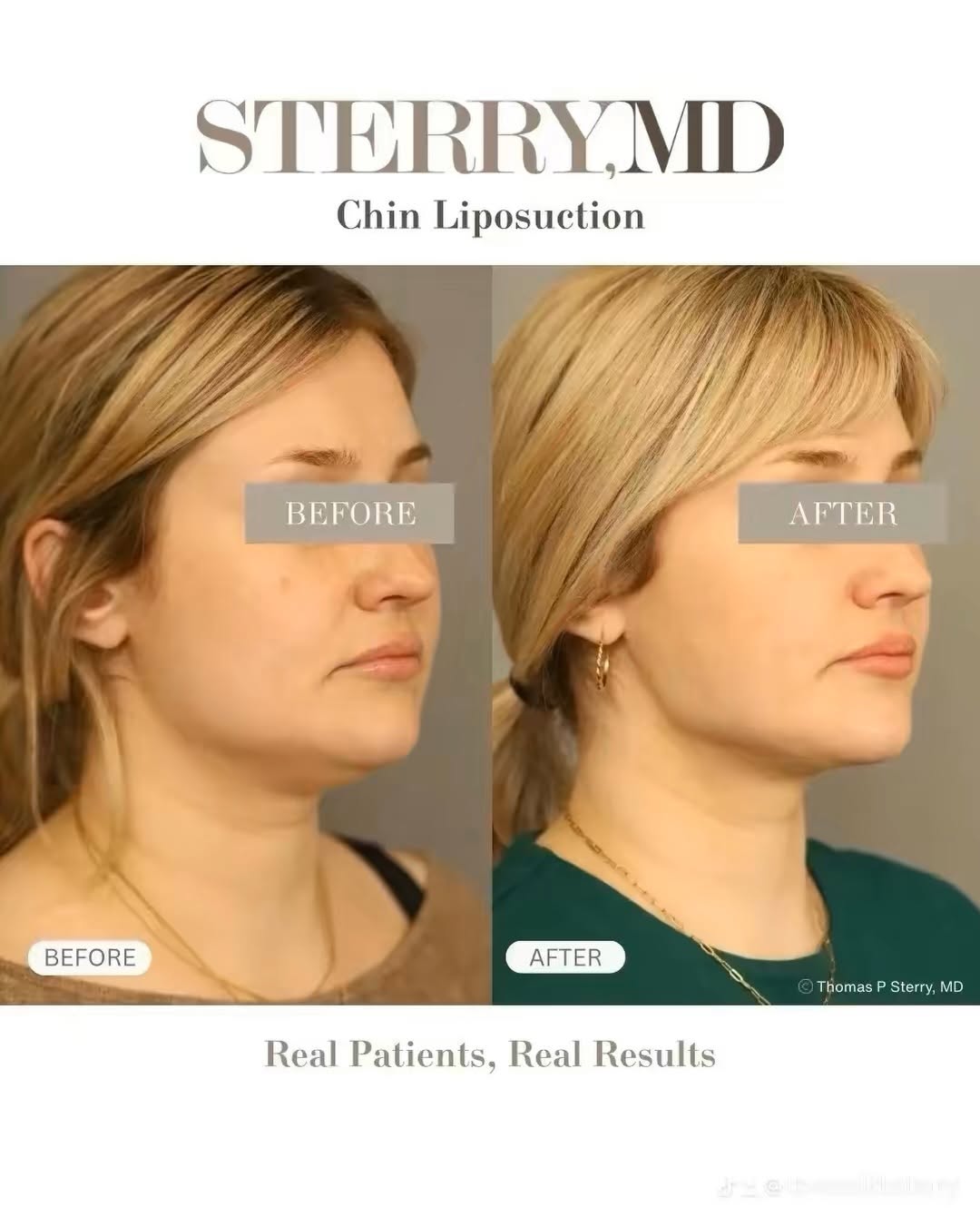 Instagram post by Dr. Thomas P. Sterry: Chin liposuction can help remove stubborn fat under the chin and create a more defined, sculpted jawline. The goal isn’t to change your face…