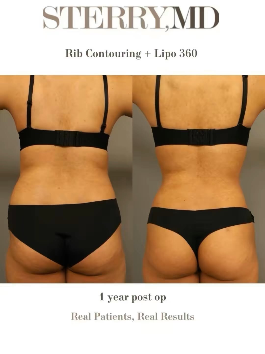Instagram post by Dr. Thomas P. Sterry: Rib contouring changes more than your waist—it transforms your silhouette from every angle. ✨ A more defined waist, a smoother shape, and a …