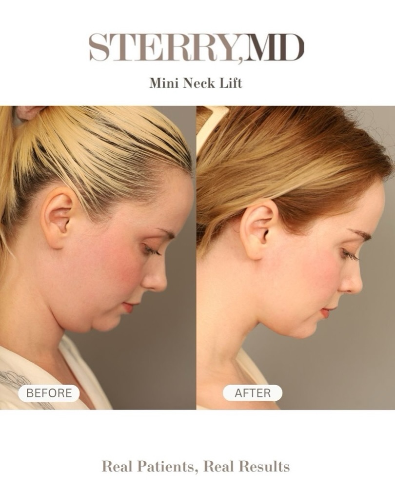 Instagram post by Dr. Thomas P. Sterry: A double chin can change your entire profile. If excess skin and laxity are part of the concern, a mini neck lift can be a great option to c…