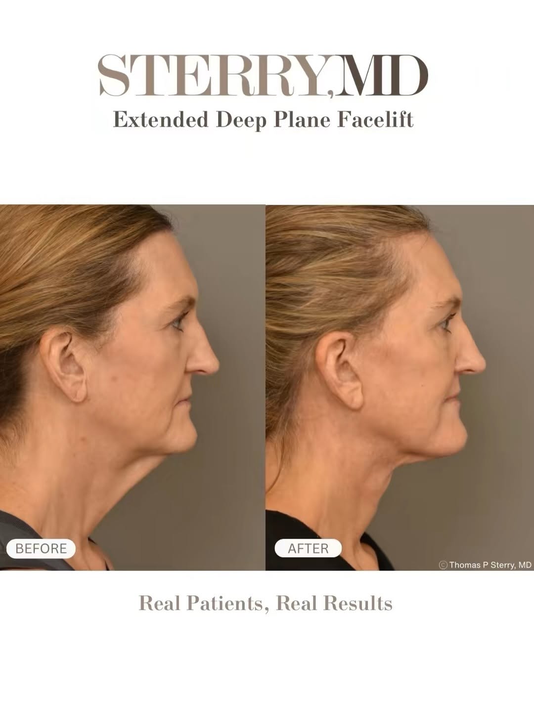 Instagram post by Dr. Thomas P. Sterry: A natural lift with the deep plane technique☺️ The deep plane facelift focuses on lifting and repositioning the deeper layers of the face ra…