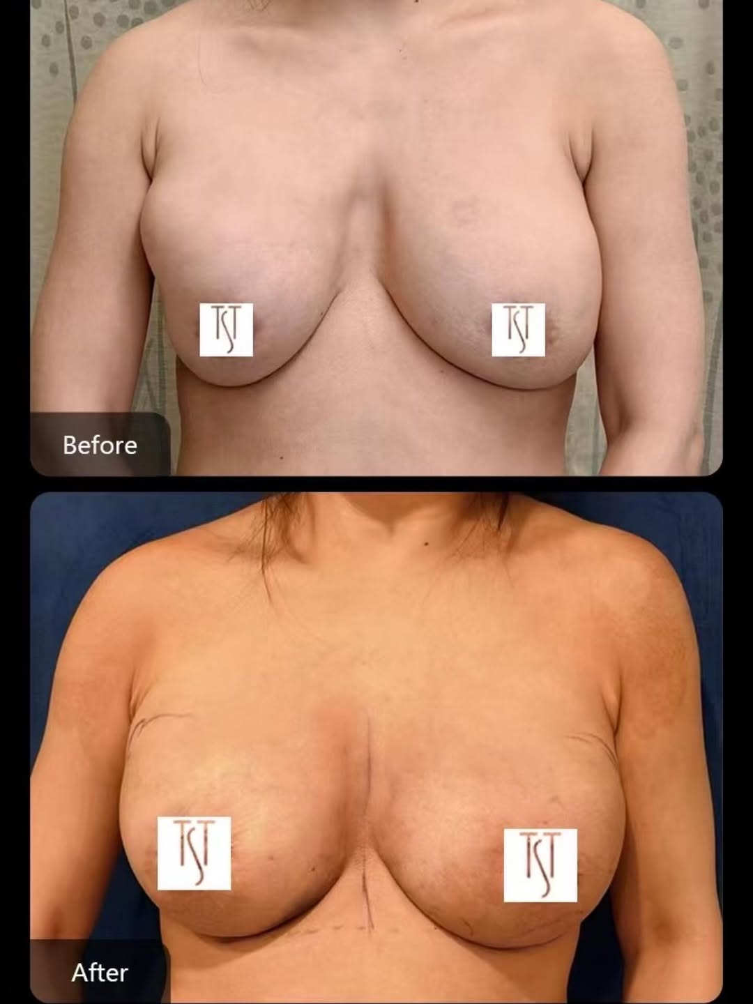 Instagram post by Dr. Thomas S. Taylor: 4 days post-op after a Breast Revision done by Dr. Taylor.‼️ ⚠️(Original Breast Augmentation done by another surgeon) ✨Procedure: Breast Imp…