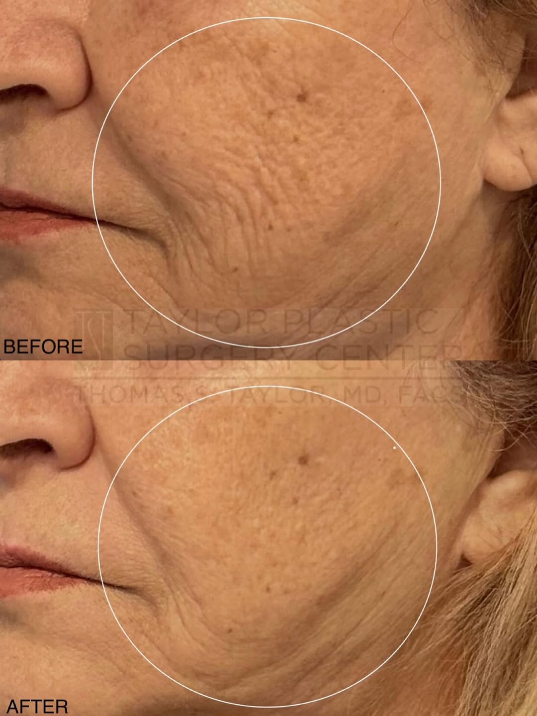 Instagram post by Dr. Thomas S. Taylor: One session. Real results. ✨ Skin tightening, smoother texture, and softened lines after just one Morpheus8 treatment—no filters, just colla…
