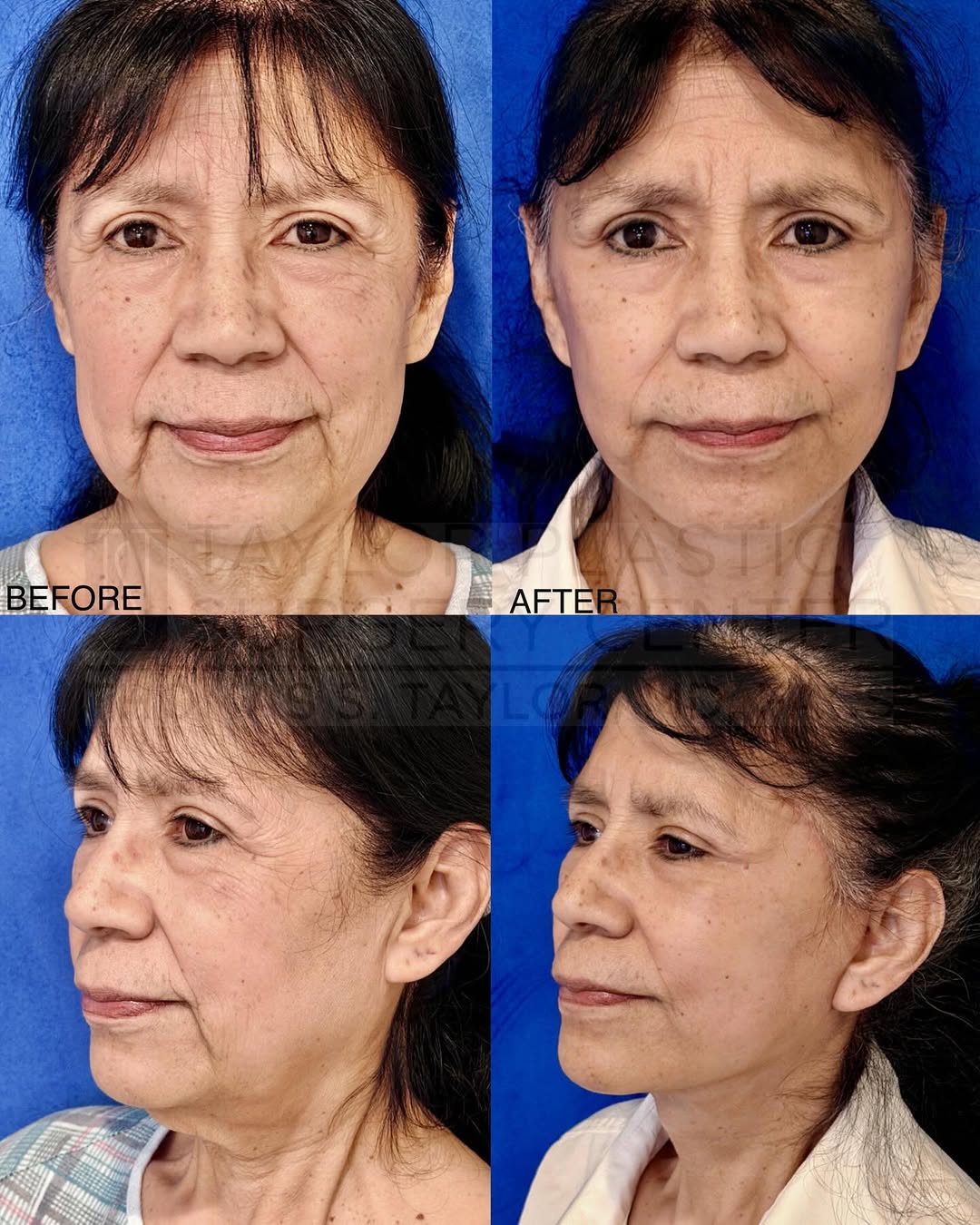 Instagram post by Dr. Thomas S. Taylor: A refreshed look without changing who she is. ✨ This full facelift helped restore definition to the jawline, smooth deeper folds, and lift t…
