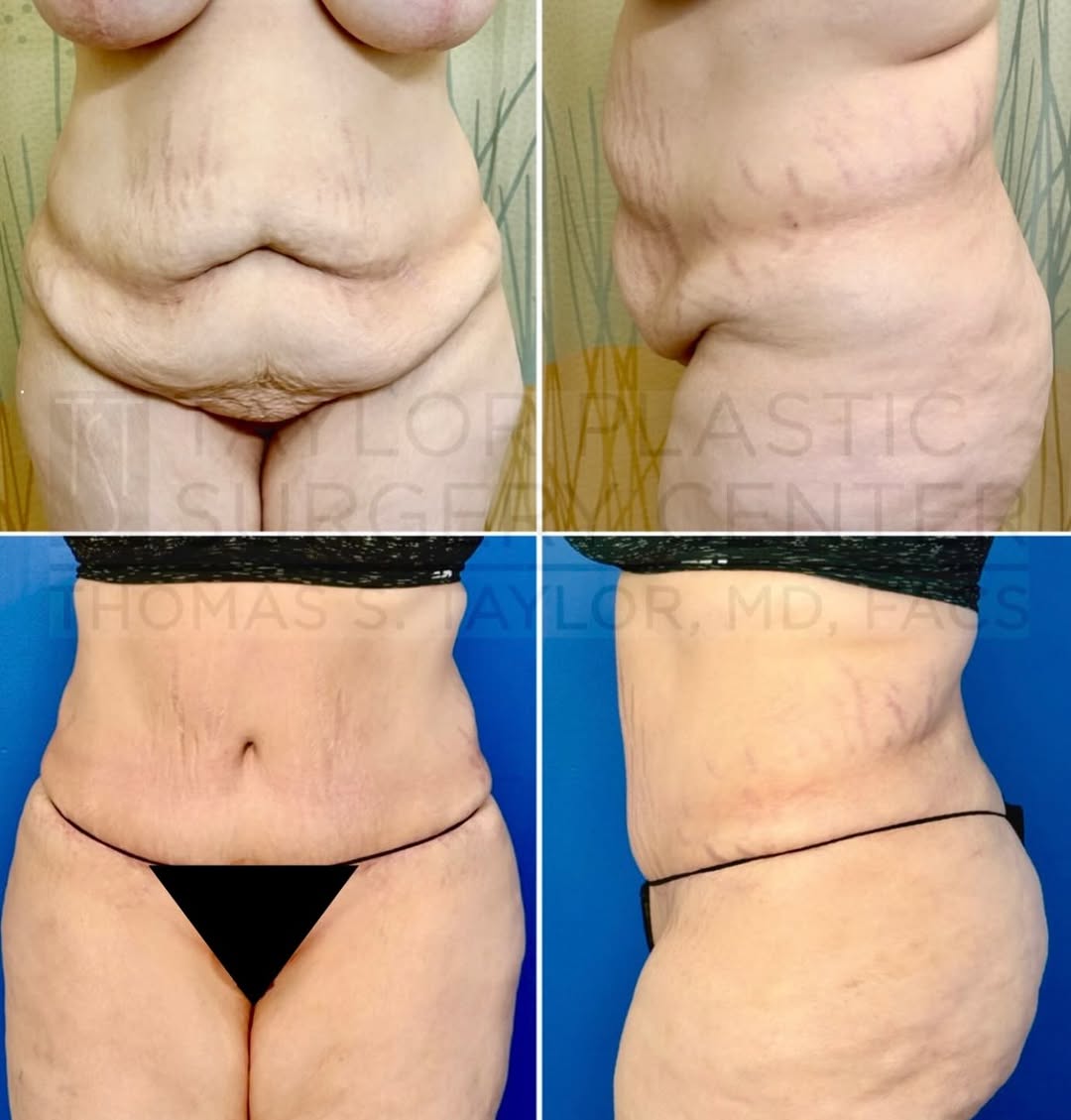 Instagram post by Dr. Thomas S. Taylor: Before and after of an Abdominoplasty done by Dr. Taylor 🤩 #abdominoplastybeforeandafter #tummytucksurgery #taylorplasticsurgerycenter #pas…
