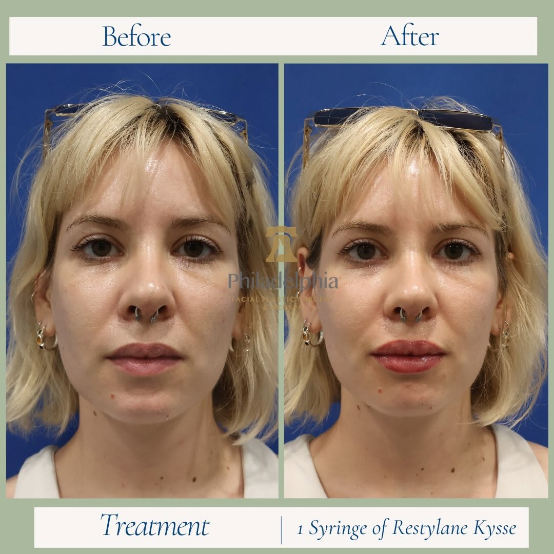 Instagram post by Dr. Thomas Spalla: A clean, natural enhancement using Restylane Kysse - crafted by Dr. Spalla! Results speak for themselves! Book a consultation today! #medspa…