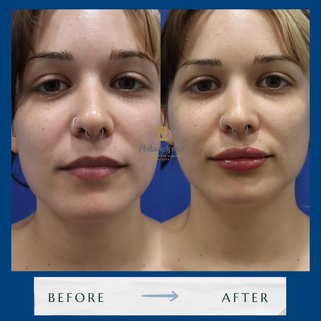 Instagram post by Dr. Thomas Spalla: A little volume can make a big difference. Our goal is always to enhance your natural features – not change them. Ready for lips that look e…