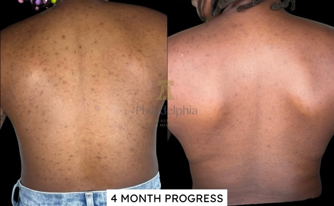 Instagram post by Dr. Thomas Spalla: Back pigmentation transformation! 😍 so happy for my client #philly #philadelphia #esthetician #acne #skincare