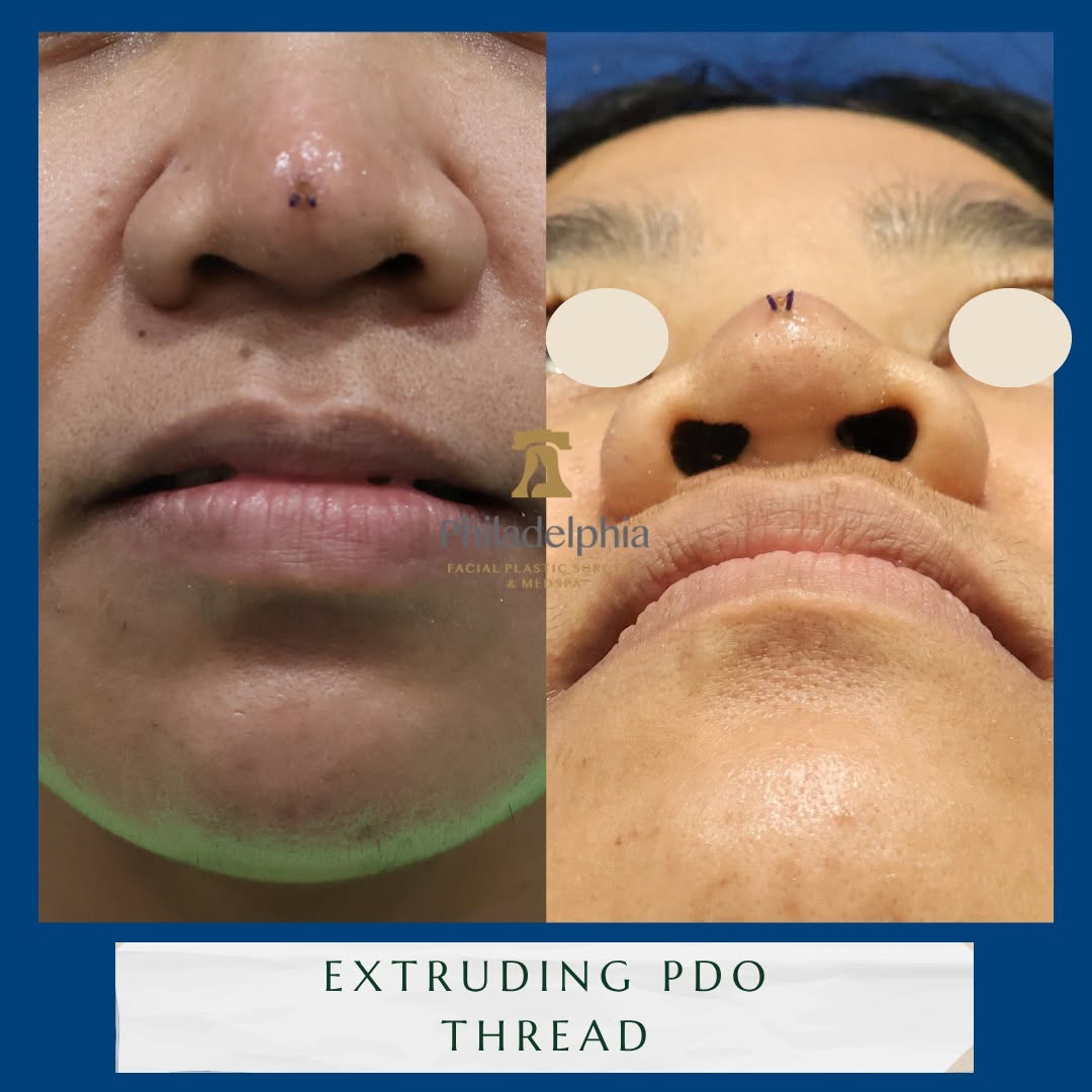 Instagram post by Dr. Thomas Spalla: Threads can extrude. If this happens, don't hesitate to contact Dr. Spalla for guidance and assistance. #drspalla #philadelphia #threadlift …