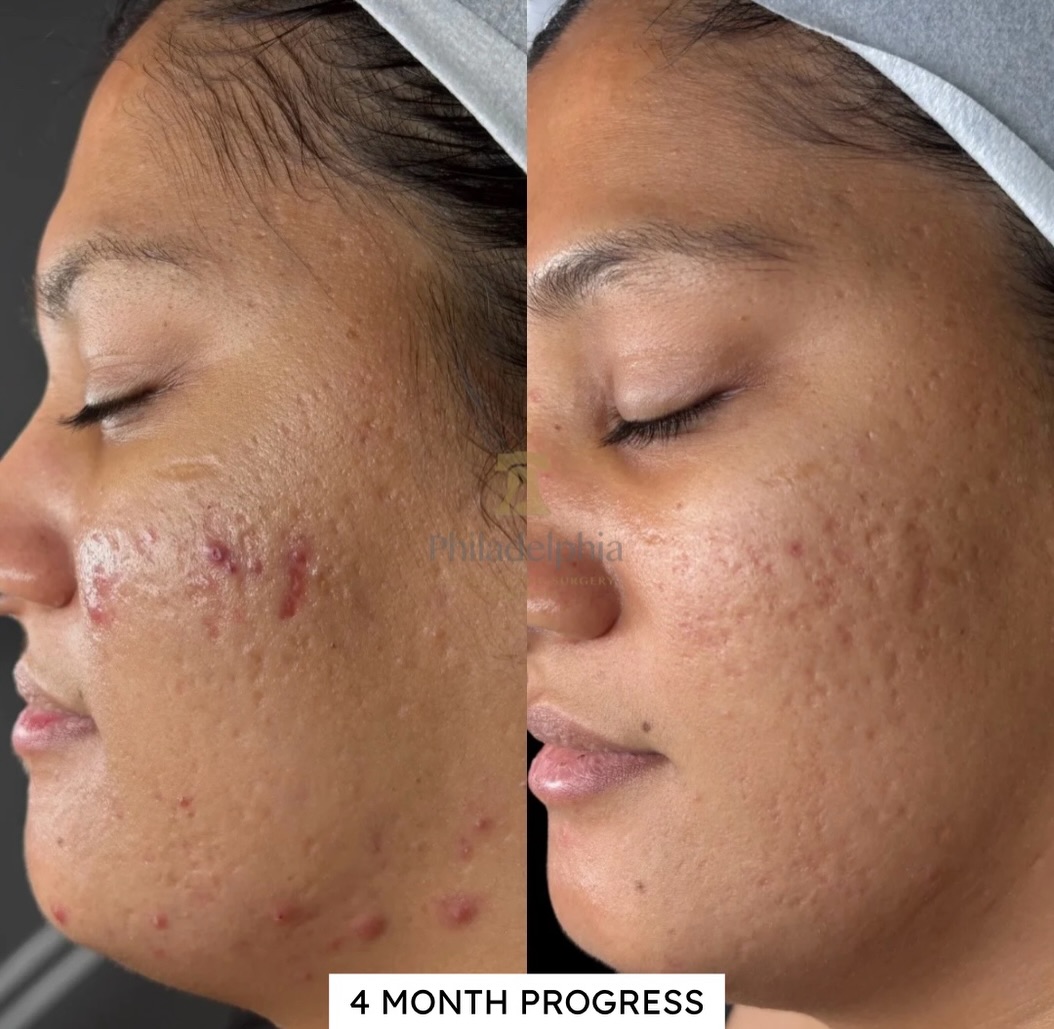 Instagram post by Dr. Thomas Spalla: Inflammation be gone 🪄 #philly #philadelphia #skincare #acne #phillymoms