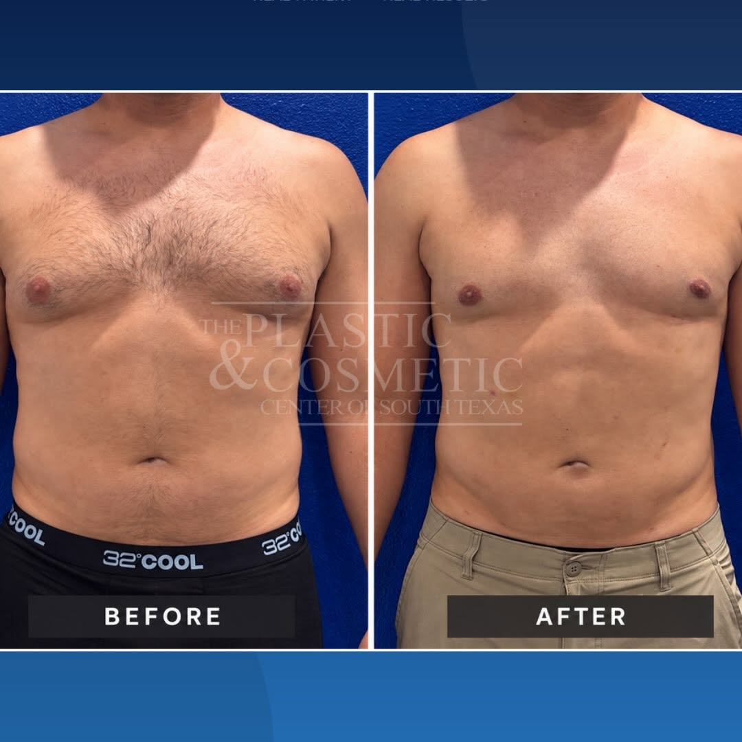 Instagram post by Dr. Thomas T. Jeneby: Men get surgery too! 💪 6 months post-op: Gynecomastia Liposuction Offering lipo specials all month long! Hit us up ⬆️