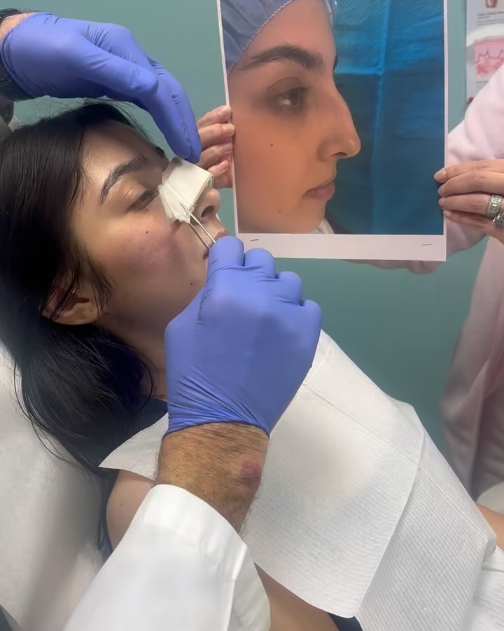 Instagram post by Dr. Thomas Trevisani: Only 10 days post op! We cant wait for all the swelling to subside and seeing final result ! #rhinoplasty #closedtechniquerhinoplasty #barbi…