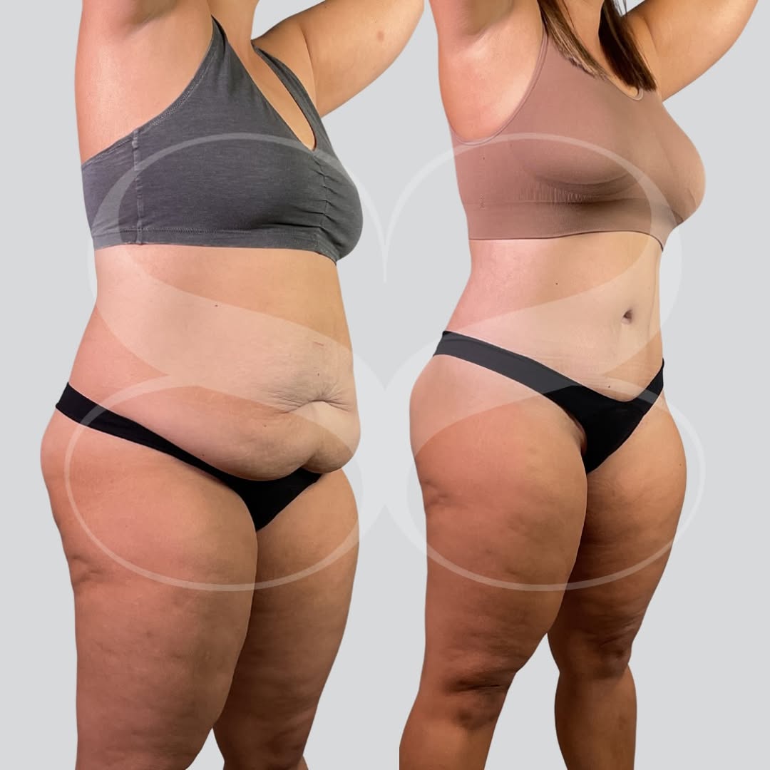 Instagram post by Dr. Thomas Trey Sands: This transformation was achieved with an extended abdominoplasty and liposuction 360 to remove excess skin, tighten the abdominal area, and …