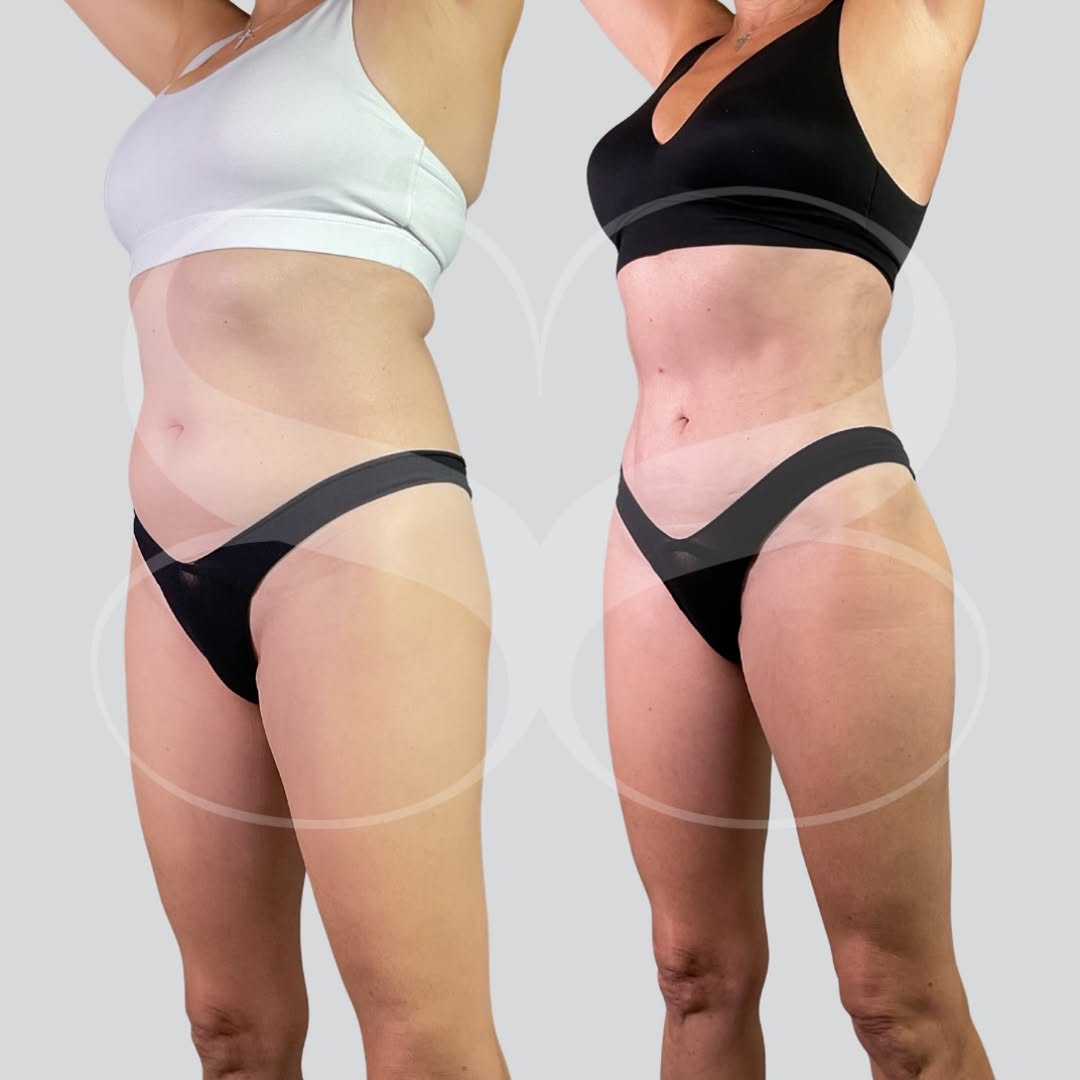 Instagram post by Dr. Thomas Trey Sands: Sculpted in her 50s Beautiful results at every age. This patient underwent liposuction of the abdomen, flanks, and full back with Renuvion t…