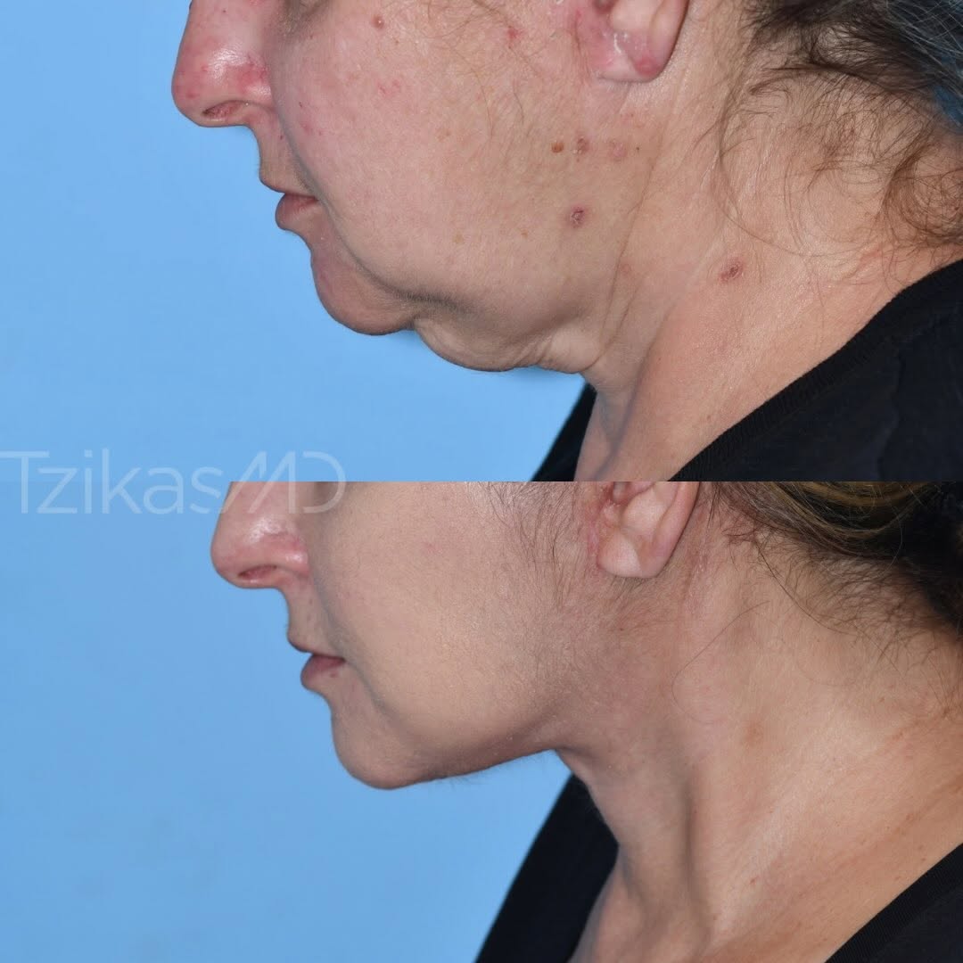 Instagram post by Dr. Thomas Tzikas: A natural facelift shouldn’t announce itself. ✨ For this patient, I performed a Volume Integrated Deep Plane Face & Neck Lift with facial li…