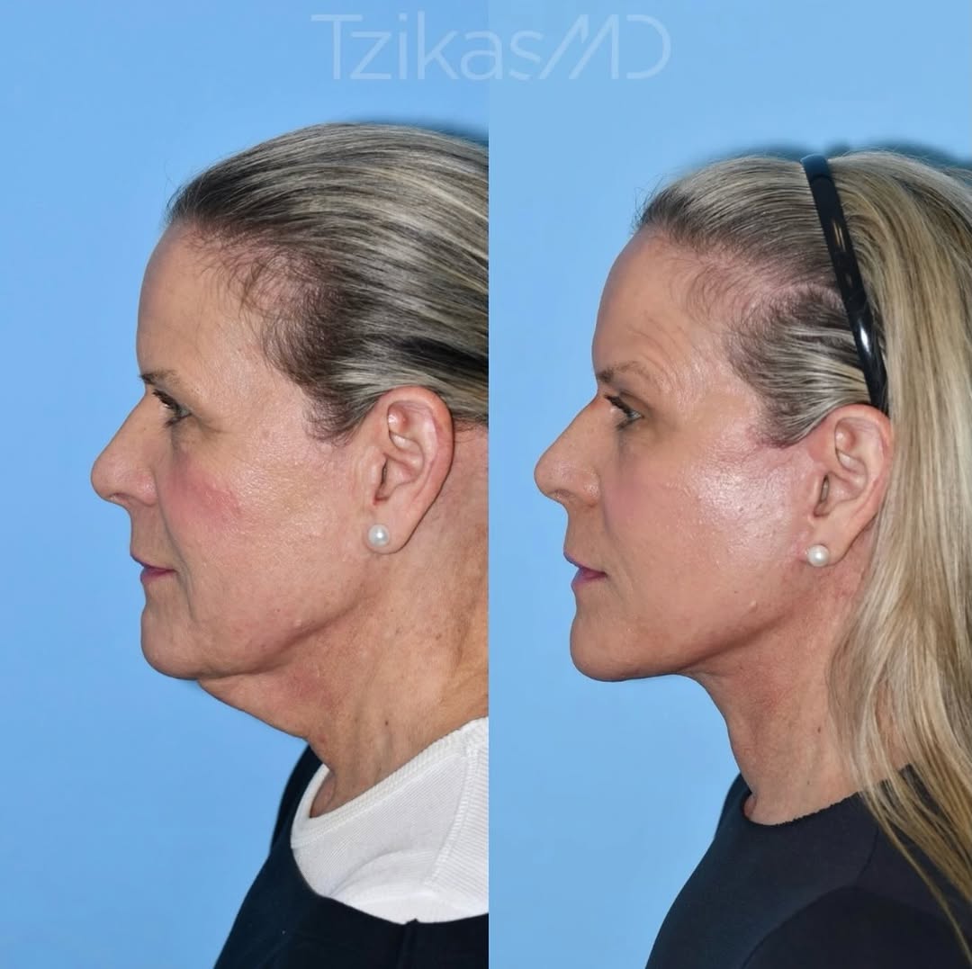 Instagram post by Dr. Thomas Tzikas: 61 never looked so good 😎👏 A natural face and neck rejuvenation is about more than tightening skin. The lower face and neck musculature mu…