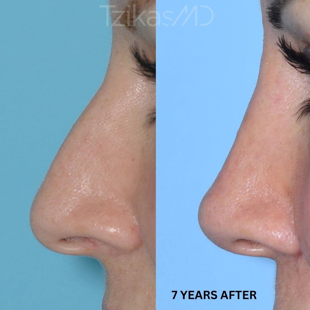 Instagram post by Dr. Thomas Tzikas: Rhinoplasty is where precision meets proportion. 👃🙌 Even small adjustments to the nose can significantly impact the overall profile. By re…