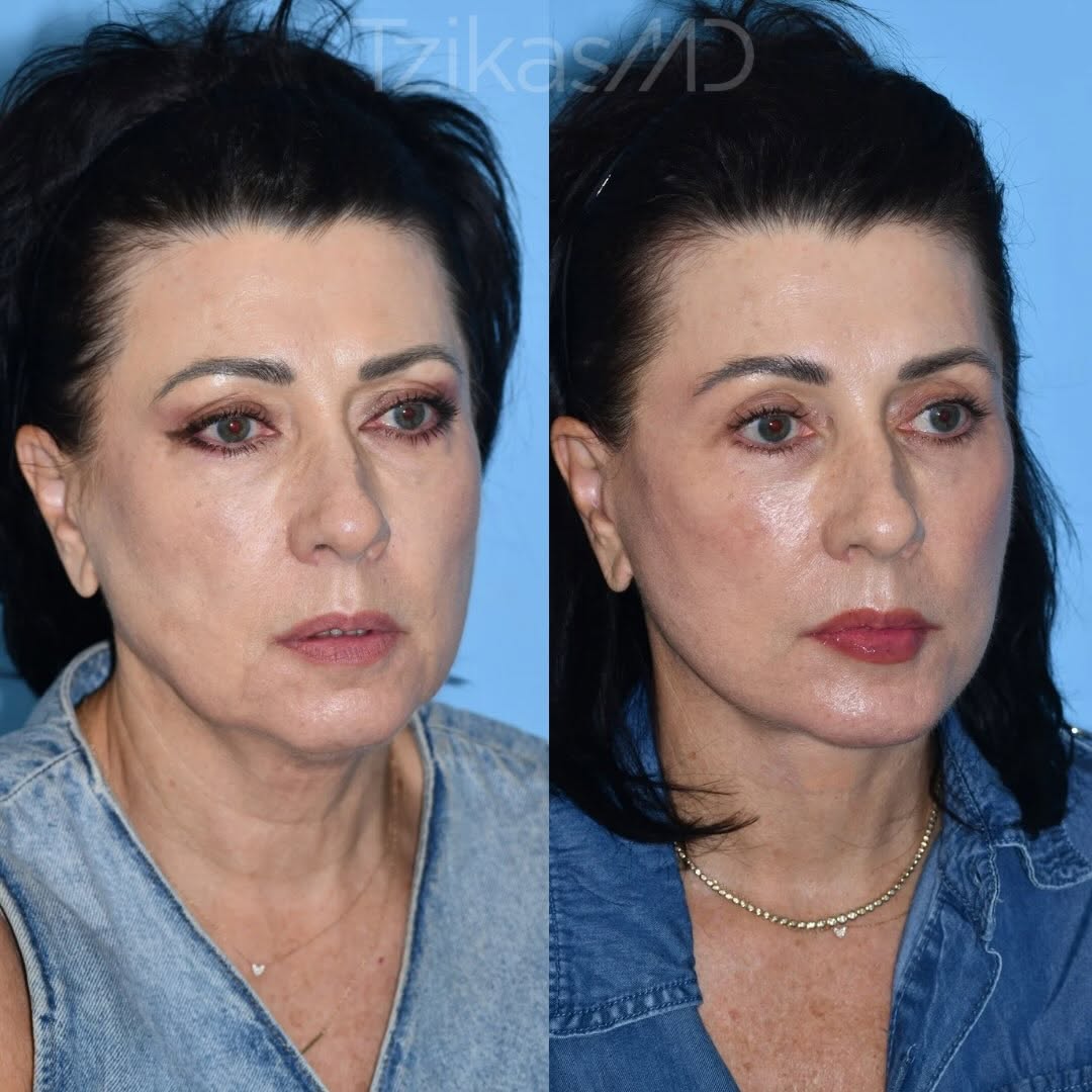 Instagram post by Dr. Thomas Tzikas: Natural doesn’t mean doing less it means doing what fits. ✨ My patient underwent an upper + lower blepharoplasty, chin implant, Lower Extend…