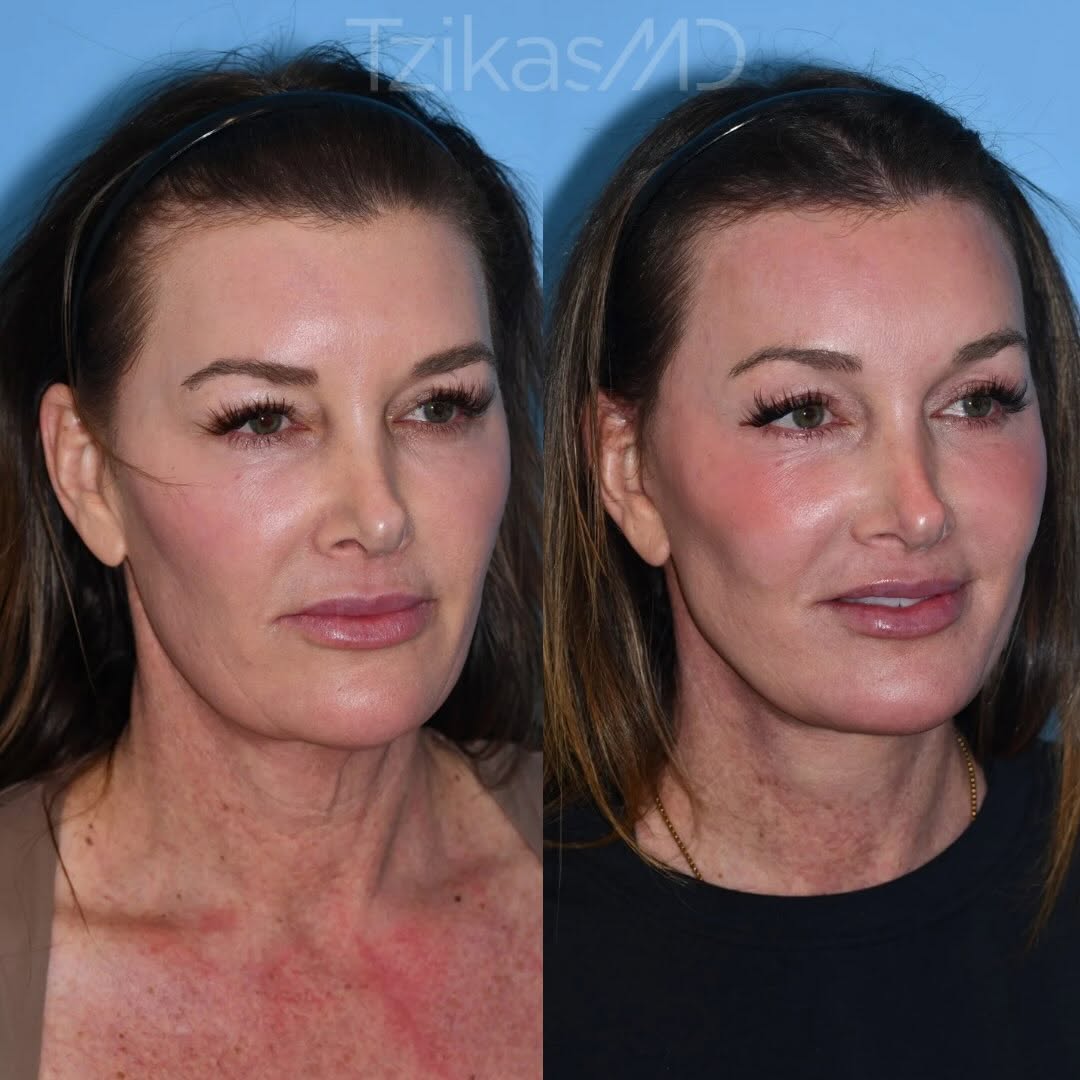 Instagram post by Dr. Thomas Tzikas: The best rejuvenation doesn’t change your face. It brings you back to a more refreshed version of yourself. ✨😎 For this patient, the goal w…