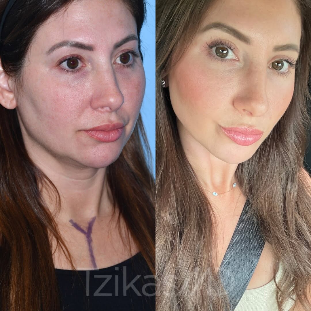Instagram post by Dr. Thomas Tzikas: Small changes. Noticeable refresh. ✨ My patient underwent an upper blepharoplasty, fat grafting to the mid and upper face, and a chin implan…