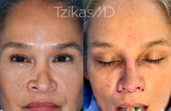 Instagram post by Dr. Thomas Tzikas: When the first rhinoplasty doesn’t give you the result you hoped for, revision becomes a different kind of surgery. 🧐 Correcting complicati…
