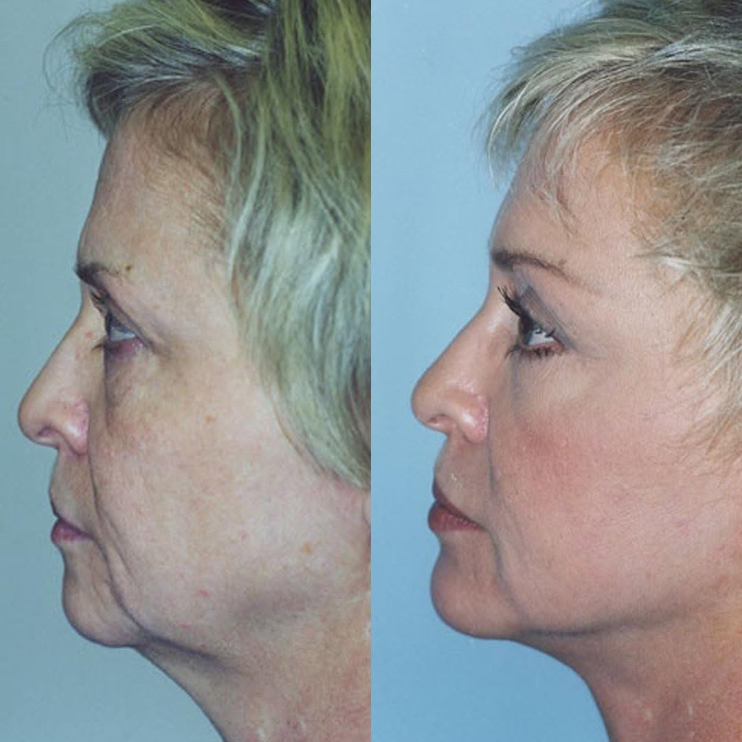 Instagram post by Dr. Thomas W. Loeb: This beautiful #facelift result shows just how rejuvenating this procedure can be! While the change is drastic, the results are quite #natur…