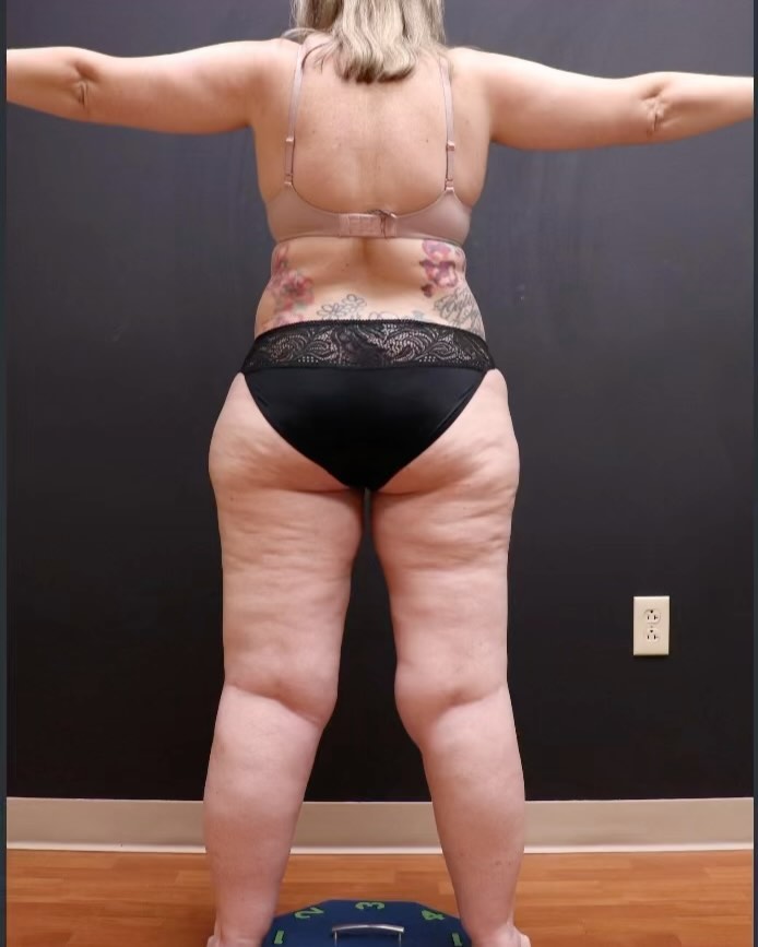 Instagram post by Dr. Thomas Wright: This lovely 💜Lipedema 💜patient came in for a pre-op to her abdomen and flanks and we decided to do a full body follow up picture to see ho…