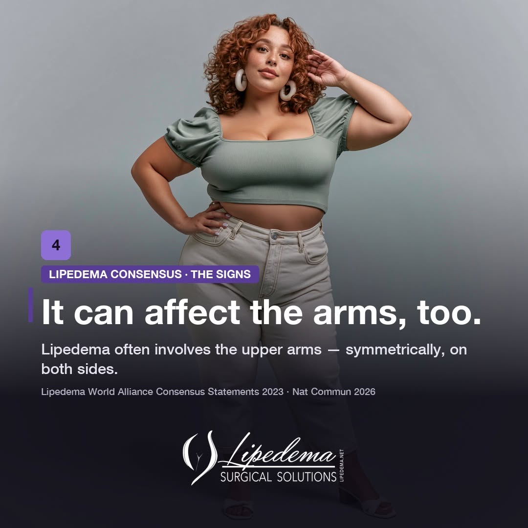 Instagram post by Dr. Thomas Wright: 📢 Statement 4: Lipedema can affect the arms, too. Lipedema is often associated with the legs, but the Lipedema World Alliance consensus pap…