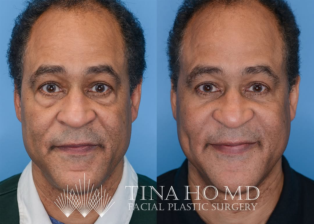 Instagram post by Dr. Thuy-Van Tina Ho: Lower Eyelid Surgery: Before and After Thuy-Van Tina Ho, MD This wonderful male patient in his 60s came to me for surgical consultation, bot…