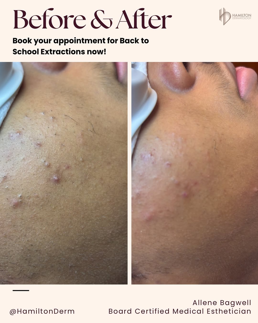 Instagram post by Dr. Tiffani Hamilton: ✨ Self-care looks good on you! ✨ Check out this amazing before & after by our talented esthetician, Allene! 💆♀️✨ Ready to give your skin a…